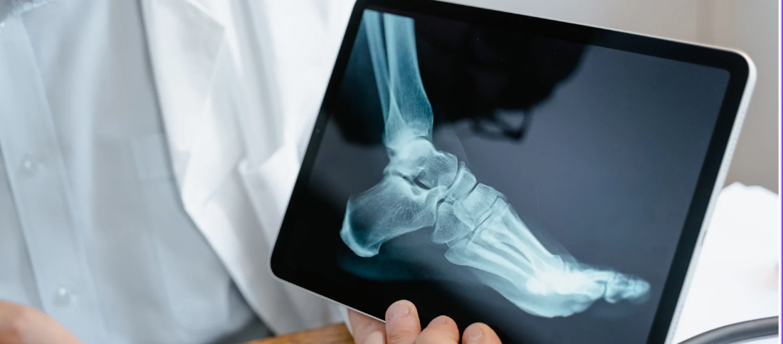 Subtalare Arthrorise - Ein Erfahrungsbericht | liebenswert-anders.de